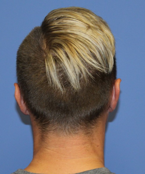 Otoplasty (Ear Pinning) 3993 – Click HERE for more views after photo. Individual results may vary.