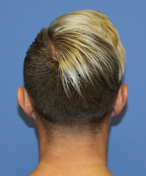 Otoplasty (Ear Pinning) 3993 – Click HERE for more views before photo. Individual results may vary.