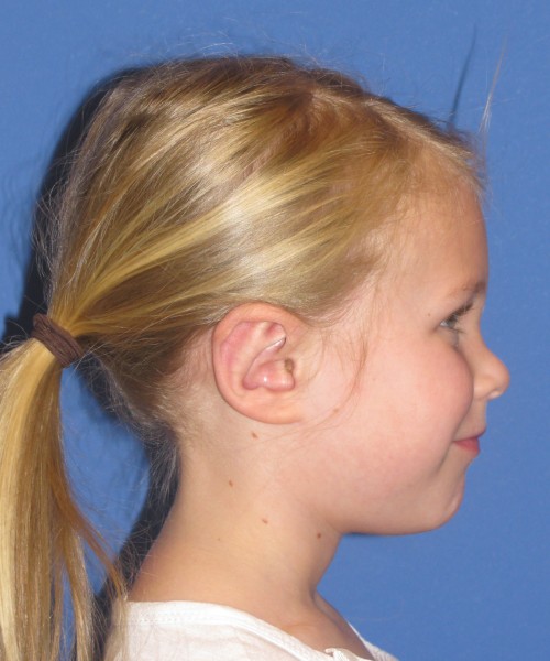 Otoplasty (Ear Pinning) 4006 – Click HERE for more views after photo. Individual results may vary.