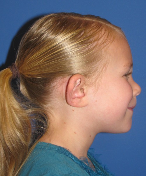Otoplasty (Ear Pinning) 4006 – Click HERE for more views before photo. Individual results may vary.