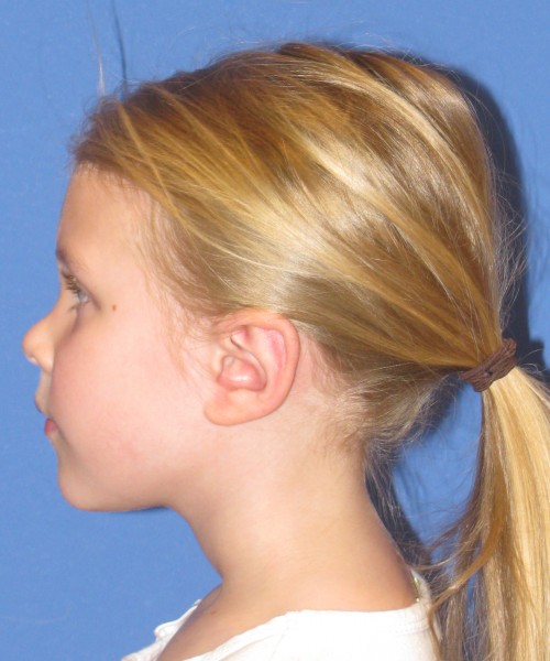 Otoplasty (Ear Pinning) 4006 – Click HERE for more views after photo. Individual results may vary.