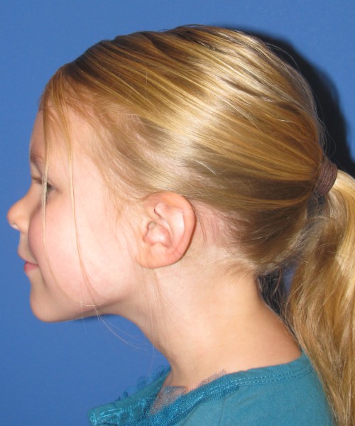 Otoplasty (Ear Pinning) 4006 – Click HERE for more views before photo. Individual results may vary.