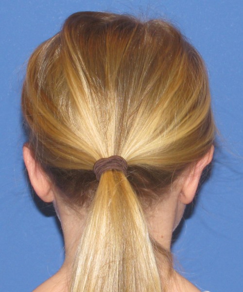 Otoplasty (Ear Pinning) 4006 – Click HERE for more views after photo. Individual results may vary.