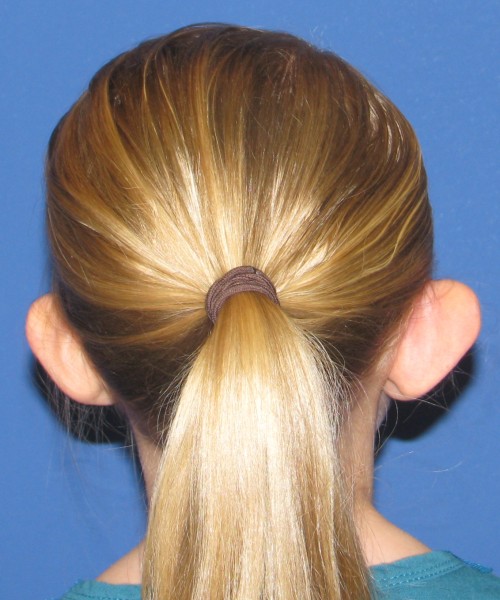 Otoplasty (Ear Pinning) 4006 – Click HERE for more views before photo. Individual results may vary.