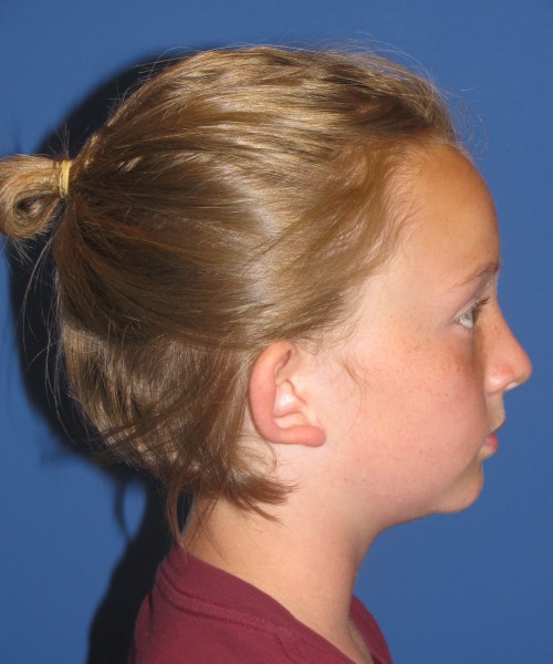 Otoplasty (ear pinning) 4020 – Click HERE for more views before photo. Individual results may vary.