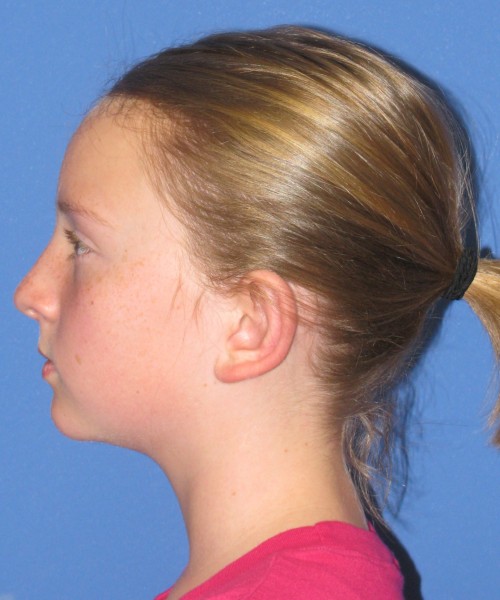 Otoplasty (ear pinning) 4020 – Click HERE for more views after photo. Individual results may vary.
