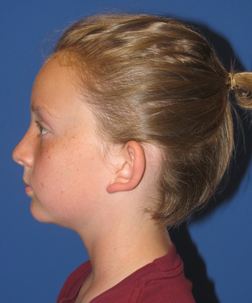Otoplasty (ear pinning) 4020 – Click HERE for more views before photo. Individual results may vary.