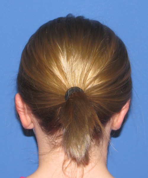 Otoplasty (ear pinning) 4020 – Click HERE for more views after photo. Individual results may vary.