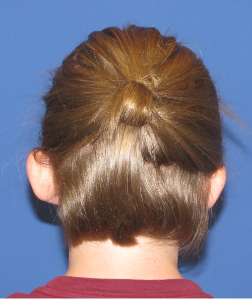 Otoplasty (ear pinning) 4020 – Click HERE for more views before photo. Individual results may vary.