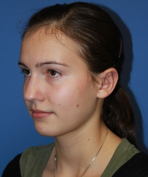 Otoplasty (Ear Pinning) 4033 – Click HERE for more views after photo. Individual results may vary.