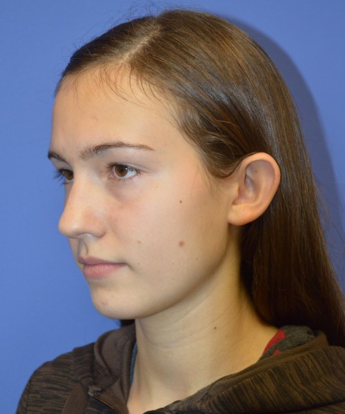 Otoplasty (Ear Pinning) 4033 – Click HERE for more views before photo. Individual results may vary.