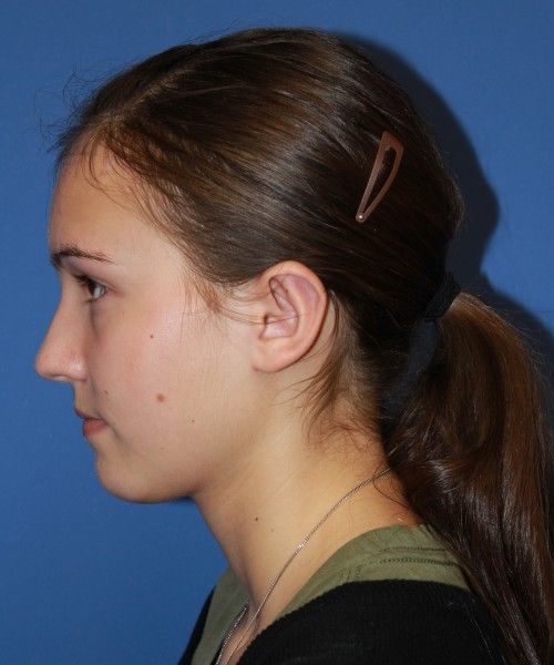 Otoplasty (Ear Pinning) 4033 – Click HERE for more views after photo. Individual results may vary.