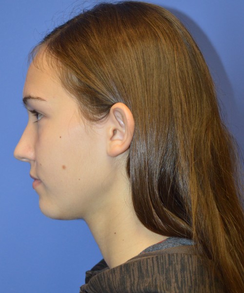 Otoplasty (Ear Pinning) 4033 – Click HERE for more views before photo. Individual results may vary.
