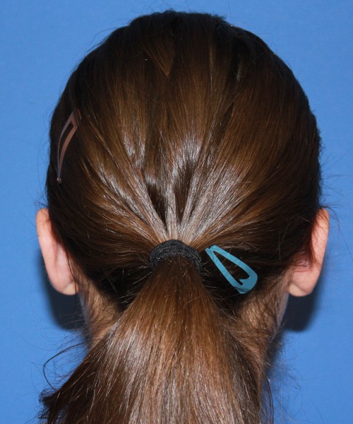 Otoplasty (Ear Pinning) 4033 – Click HERE for more views after photo. Individual results may vary.