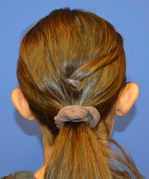 Otoplasty (Ear Pinning) 4033 – Click HERE for more views before photo. Individual results may vary.