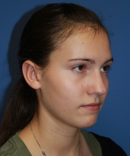 Otoplasty (Ear Pinning) 4033 – Click HERE for more views after photo. Individual results may vary.