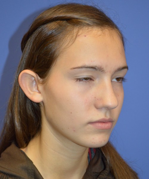 Otoplasty (Ear Pinning) 4033 – Click HERE for more views before photo. Individual results may vary.