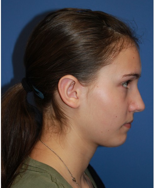 Otoplasty (Ear Pinning) 4033 – Click HERE for more views after photo. Individual results may vary.