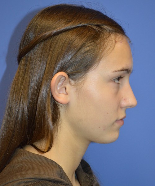 Otoplasty (Ear Pinning) 4033 – Click HERE for more views before photo. Individual results may vary.