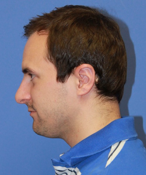 Revision Otoplasty (Ear Pinning) 4057 – Click HERE for more views after photo. Individual results may vary.