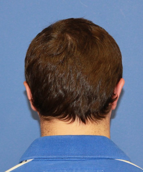 Revision Otoplasty (Ear Pinning) 4057 – Click HERE for more views after photo. Individual results may vary.