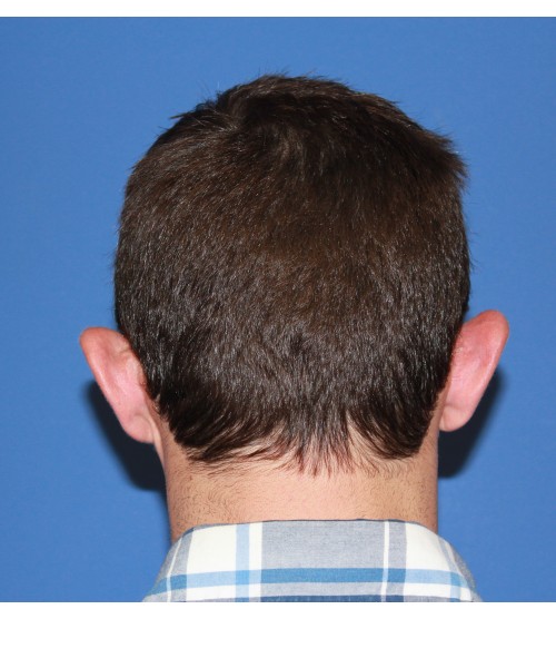 Revision Otoplasty (Ear Pinning) 4057 – Click HERE for more views before photo. Individual results may vary.
