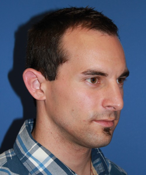 Revision Otoplasty (Ear Pinning) 4057 – Click HERE for more views before photo. Individual results may vary.