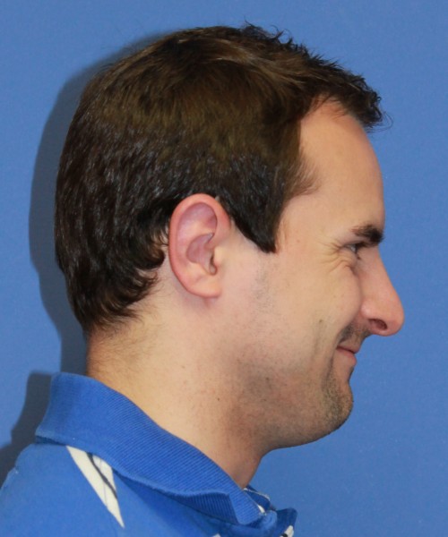 Revision Otoplasty (Ear Pinning) 4057 – Click HERE for more views after photo. Individual results may vary.
