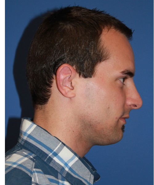 Revision Otoplasty (Ear Pinning) 4057 – Click HERE for more views before photo. Individual results may vary.