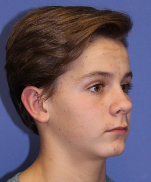 Otoplasty (Ear Pinning) 4075 – Click HERE for more views after photo. Individual results may vary.