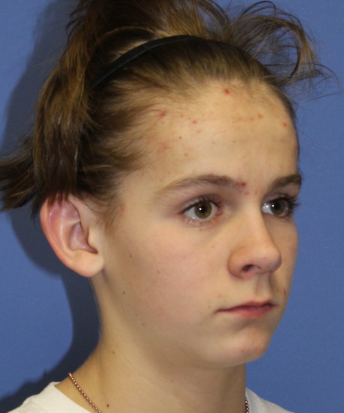 Otoplasty (Ear Pinning) 4075 – Click HERE for more views before photo. Individual results may vary.