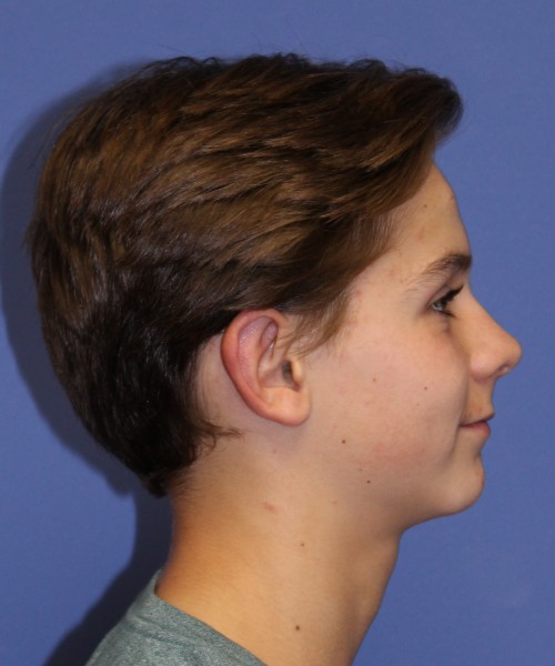 Otoplasty (Ear Pinning) 4075 – Click HERE for more views after photo. Individual results may vary.