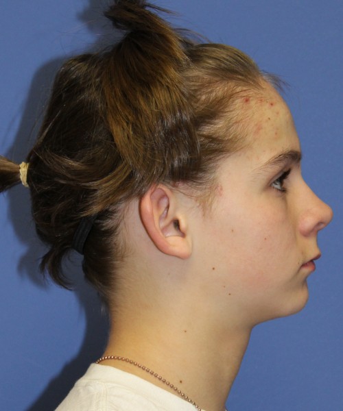 Otoplasty (Ear Pinning) 4075 – Click HERE for more views before photo. Individual results may vary.