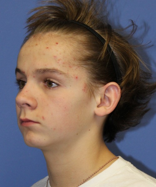 Otoplasty (Ear Pinning) 4075 – Click HERE for more views before photo. Individual results may vary.