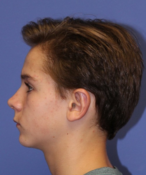 Otoplasty (Ear Pinning) 4075 – Click HERE for more views after photo. Individual results may vary.