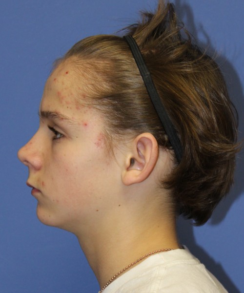 Otoplasty (Ear Pinning) 4075 – Click HERE for more views before photo. Individual results may vary.