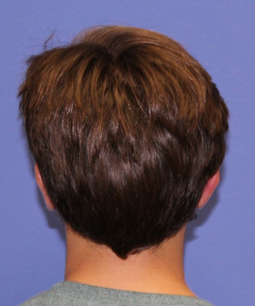 Otoplasty (Ear Pinning) 4075 – Click HERE for more views after photo. Individual results may vary.