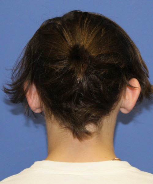Otoplasty (Ear Pinning) 4075 – Click HERE for more views before photo. Individual results may vary.