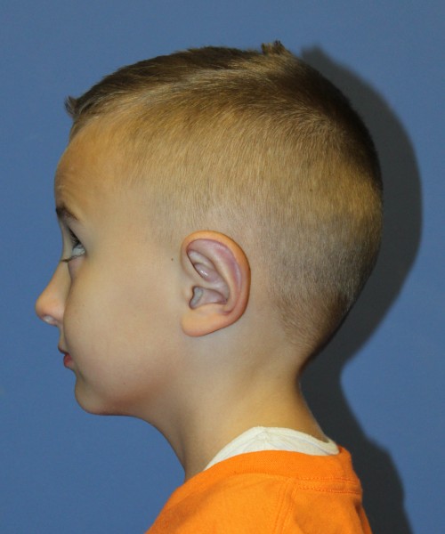 Otoplasty 4088 (Ear Pinning) – Click HERE for more views after photo. Individual results may vary.