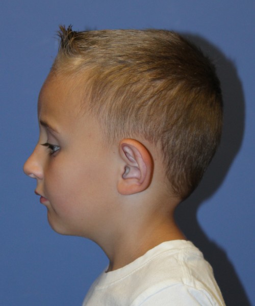 Otoplasty 4088 (Ear Pinning) – Click HERE for more views before photo. Individual results may vary.