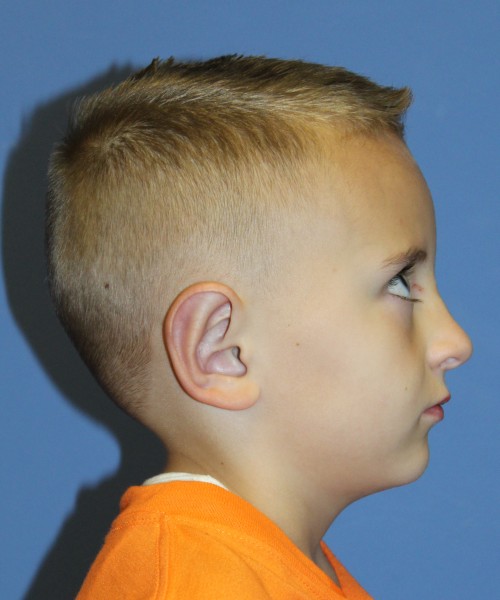 Otoplasty 4088 (Ear Pinning) – Click HERE for more views after photo. Individual results may vary.