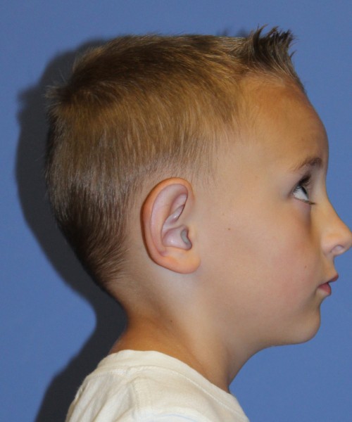 Otoplasty 4088 (Ear Pinning) – Click HERE for more views before photo. Individual results may vary.