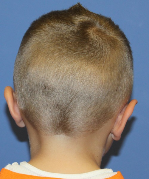Otoplasty 4088 (Ear Pinning) – Click HERE for more views after photo. Individual results may vary.