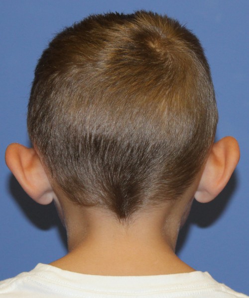 Otoplasty 4088 (Ear Pinning) – Click HERE for more views before photo. Individual results may vary.