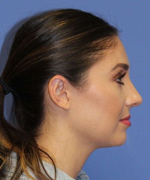 Otoplasty (Ear Pinning) 4104 – Click HERE for more views after photo. Individual results may vary.