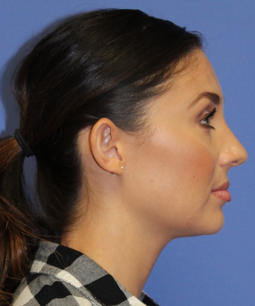 Otoplasty (Ear Pinning) 4104 – Click HERE for more views before photo. Individual results may vary.
