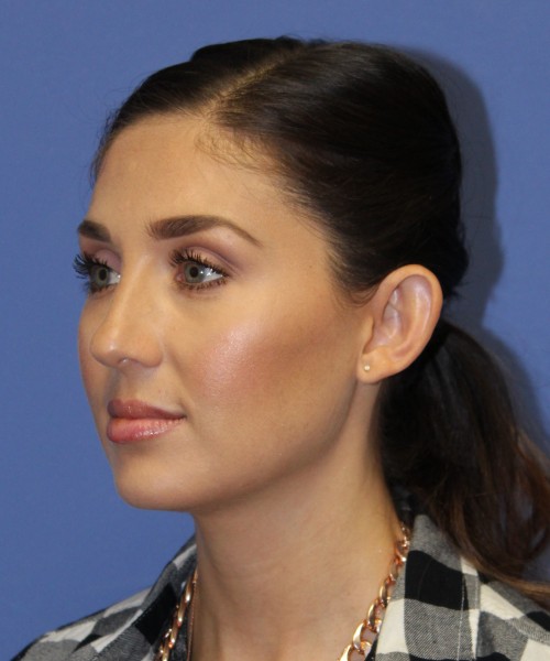 Otoplasty (Ear Pinning) 4104 – Click HERE for more views before photo. Individual results may vary.