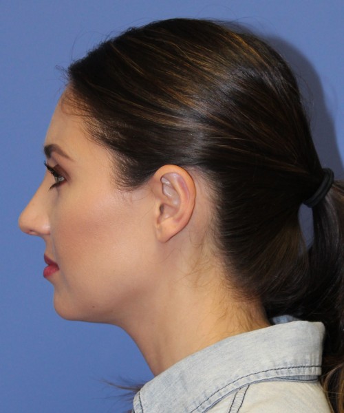 Otoplasty (Ear Pinning) 4104 – Click HERE for more views after photo. Individual results may vary.