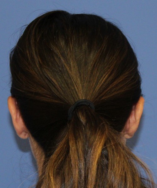 Otoplasty (Ear Pinning) 4104 – Click HERE for more views after photo. Individual results may vary.
