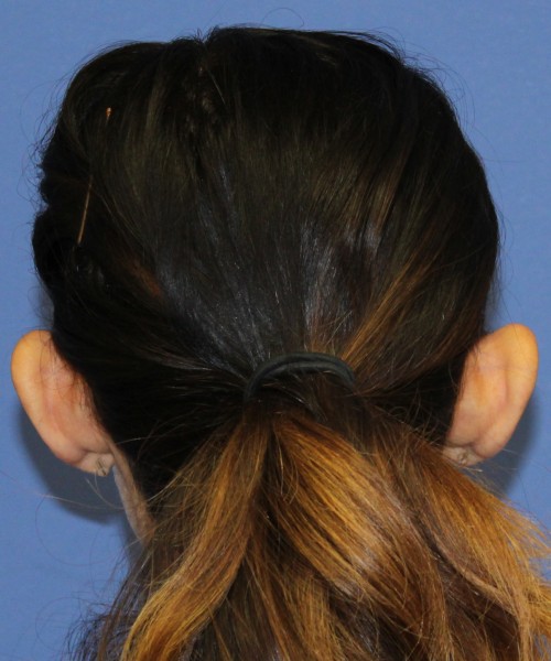 Otoplasty (Ear Pinning) 4104 – Click HERE for more views before photo. Individual results may vary.